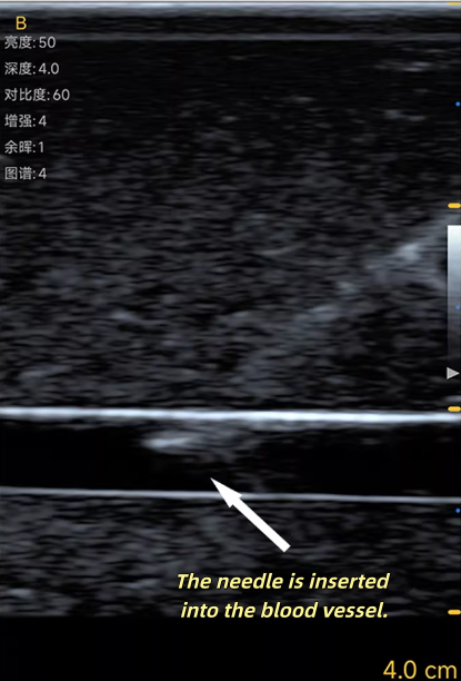 Ultrasound Vascular Puncture T - Medical Gel Ultrasound 리뷰 및 가격